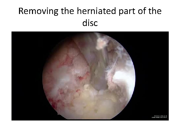 Removing the herniated part of the disc 