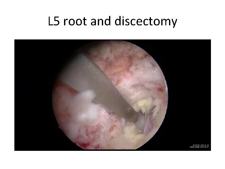 L 5 root and discectomy 