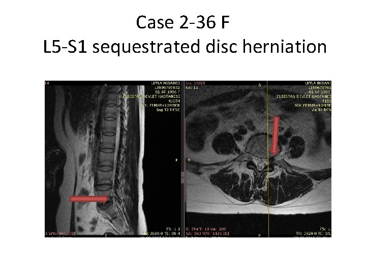 Case 2 -36 F L 5 -S 1 sequestrated disc herniation 