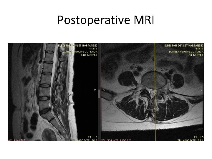 Postoperative MRI 