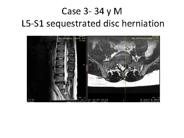 Case 3 - 34 y M L 5 -S 1 sequestrated disc herniation 