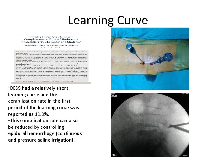 Learning Curve • BESS had a relatively short learning curve and the complication rate