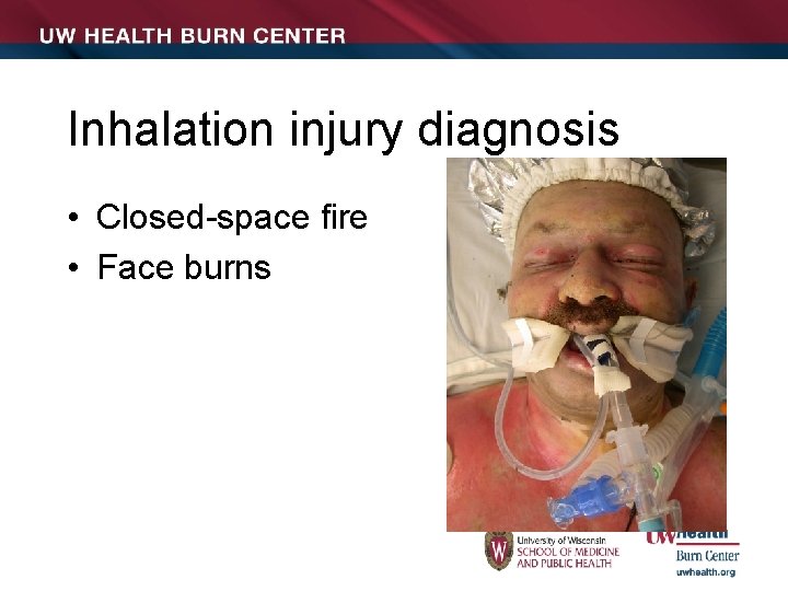 Inhalation injury diagnosis • Closed-space fire • Face burns 