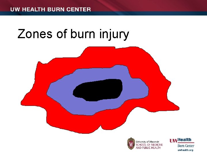 Zones of burn injury 