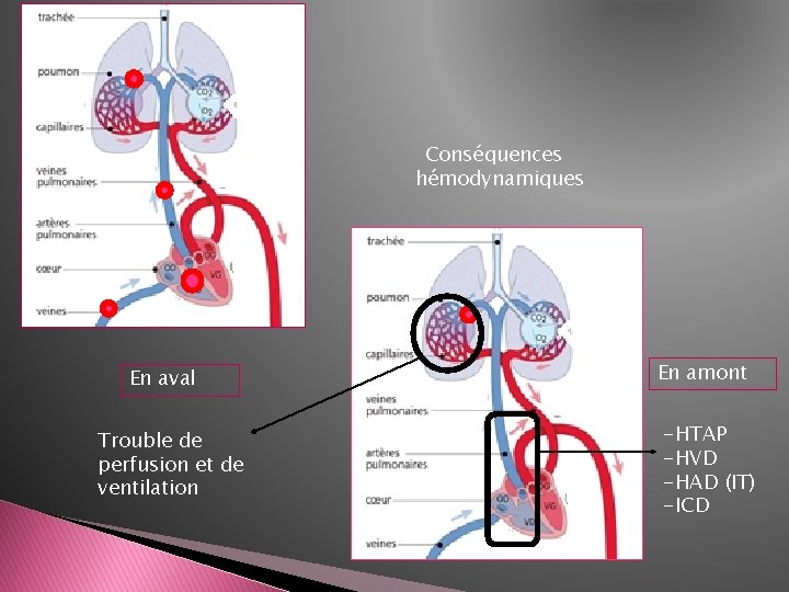 Conséquences hémodynamiques En aval Trouble de perfusion et de ventilation En amont -HTAP -HVD