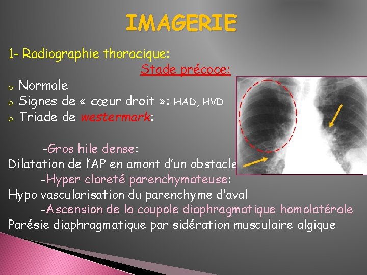 IMAGERIE 1 - Radiographie thoracique: Stade précoce: o Normale o Signes de « cœur IMAGERIE 1 - Radiographie thoracique: Stade précoce: o Normale o Signes de « cœur