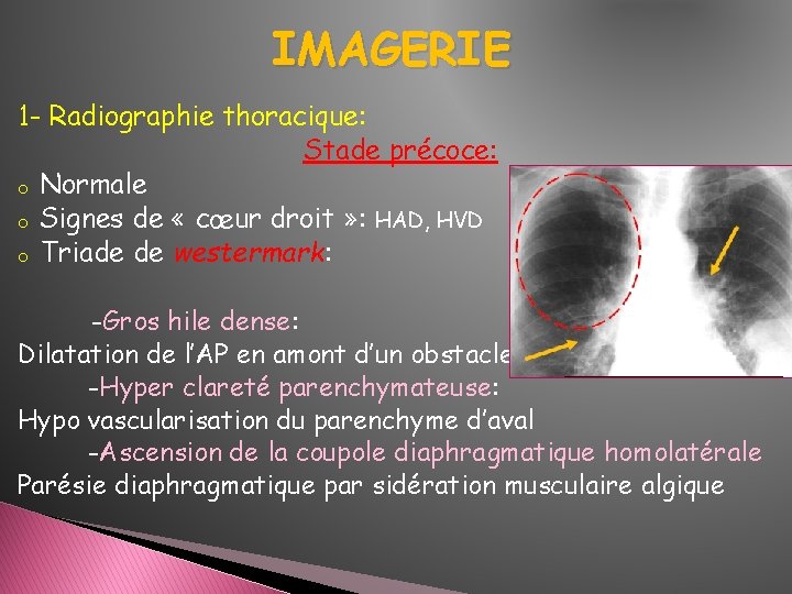 IMAGERIE 1 - Radiographie thoracique: Stade précoce: o Normale o Signes de « cœur