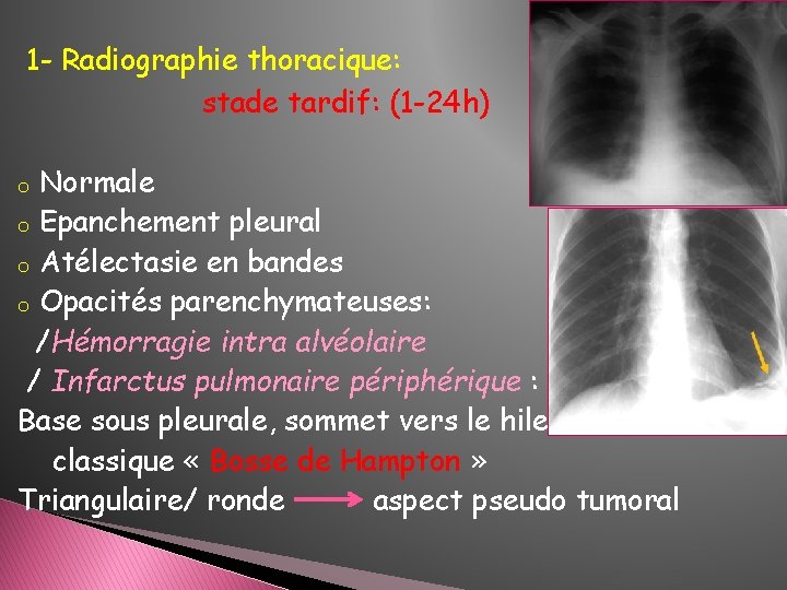 1 - Radiographie thoracique: stade tardif: (1 -24 h) Normale o Epanchement pleural o 1 - Radiographie thoracique: stade tardif: (1 -24 h) Normale o Epanchement pleural o