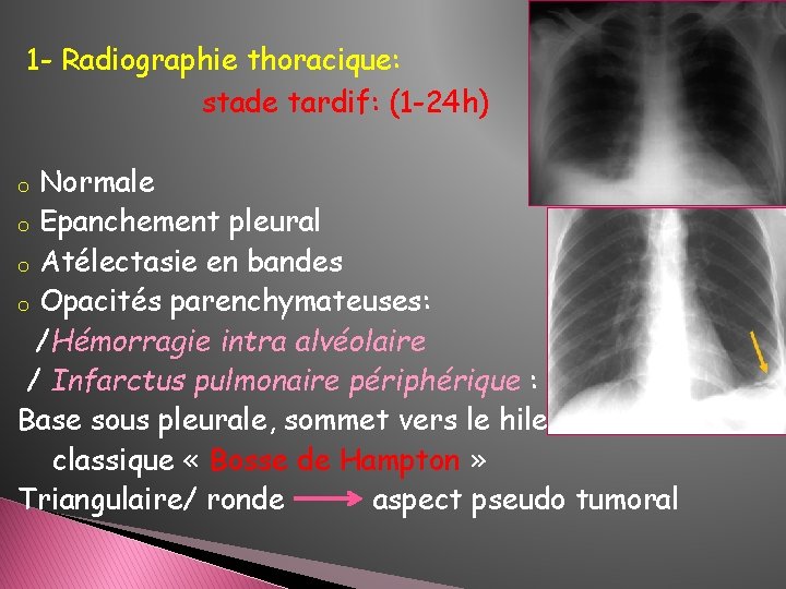 1 - Radiographie thoracique: stade tardif: (1 -24 h) Normale o Epanchement pleural o