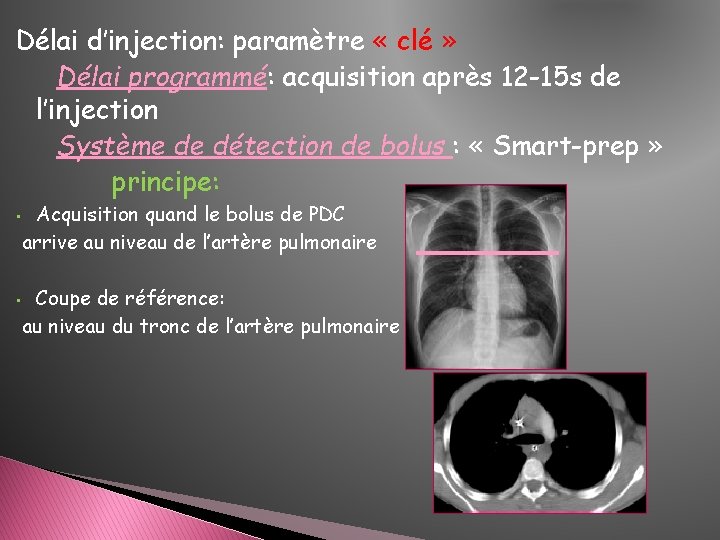 Délai d’injection: paramètre « clé » Délai programmé: acquisition après 12 -15 s de