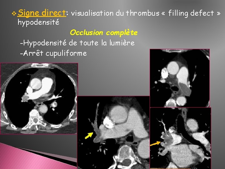 v Signe direct: visualisation du thrombus « filling defect » hypodensité Occlusion complète -Hypodensité