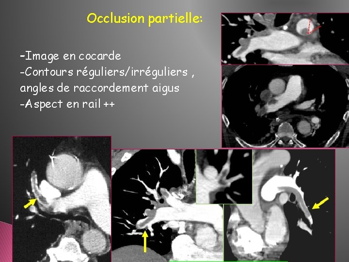 Occlusion partielle: -Image en cocarde -Contours réguliers/irréguliers , angles de raccordement aigus -Aspect en