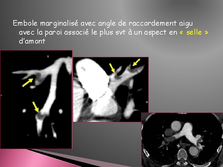 Embole marginalisé avec angle de raccordement aigu avec la paroi associé le plus svt Embole marginalisé avec angle de raccordement aigu avec la paroi associé le plus svt