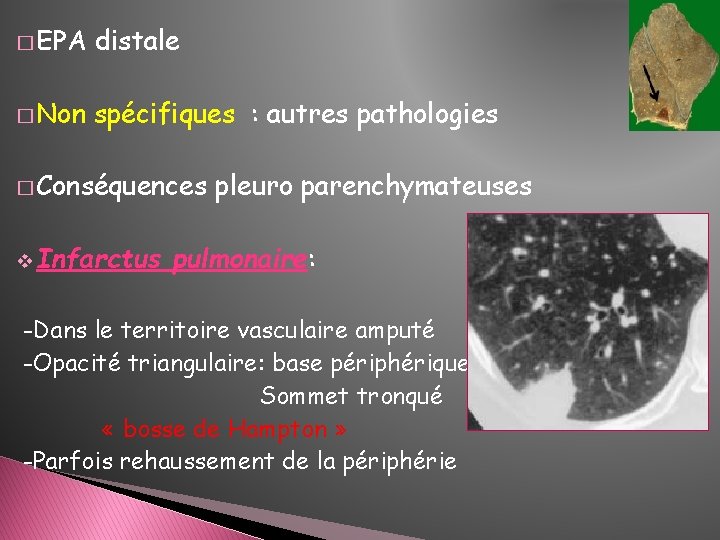 � EPA distale � Non spécifiques : autres pathologies � Conséquences v Infarctus pleuro � EPA distale � Non spécifiques : autres pathologies � Conséquences v Infarctus pleuro