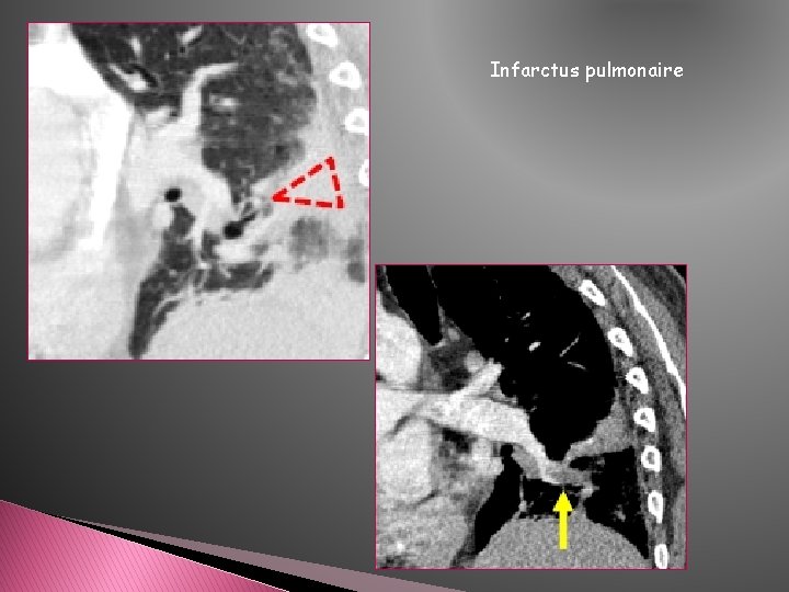 Infarctus pulmonaire Infarctus pulmonaire