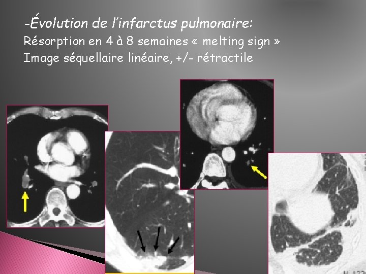 -Évolution de l’infarctus pulmonaire: Résorption en 4 à 8 semaines « melting sign » -Évolution de l’infarctus pulmonaire: Résorption en 4 à 8 semaines « melting sign »