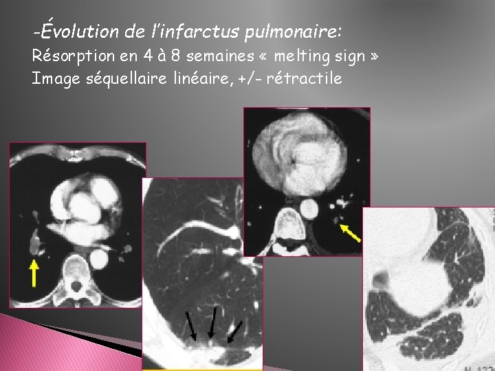 -Évolution de l’infarctus pulmonaire: Résorption en 4 à 8 semaines « melting sign »