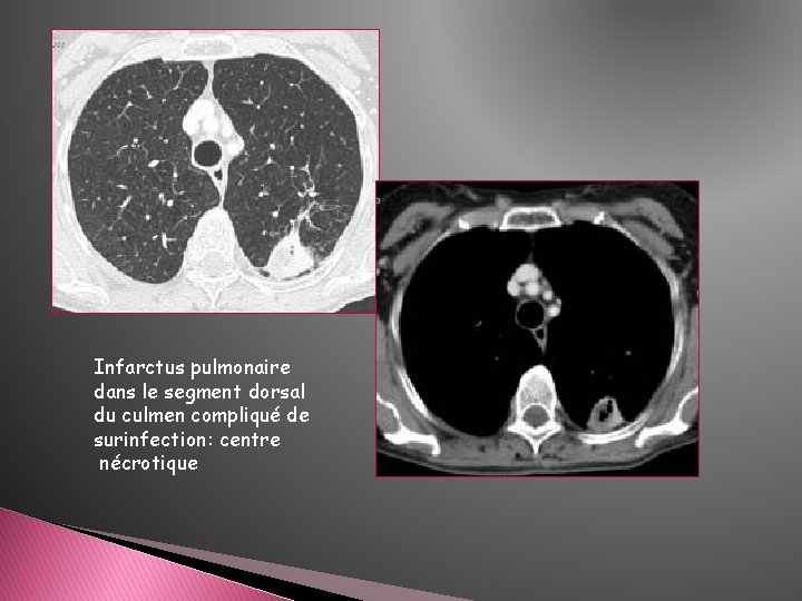 Infarctus pulmonaire dans le segment dorsal du culmen compliqué de surinfection: centre nécrotique Infarctus pulmonaire dans le segment dorsal du culmen compliqué de surinfection: centre nécrotique