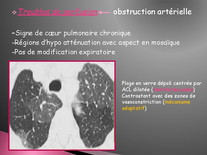 v Troubles de perfusion obstruction artérielle -Signe de cœur pulmonaire chronique -Régions d’hypo atténuation