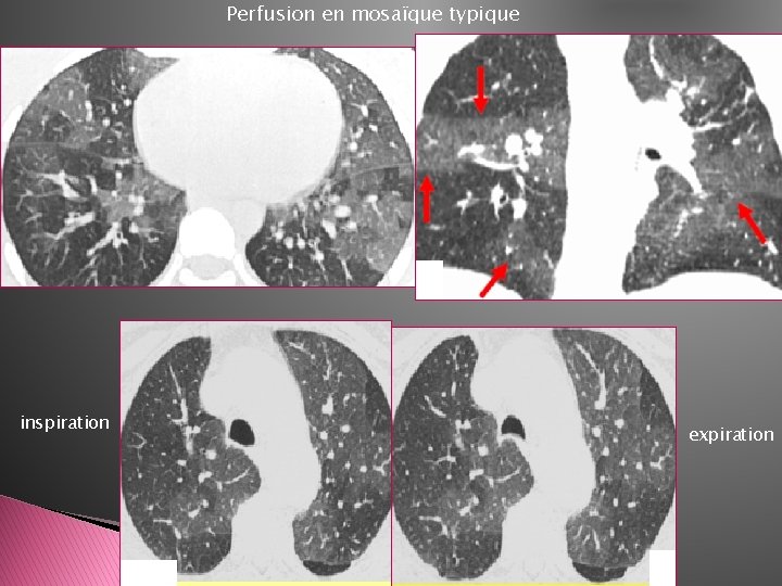 Perfusion en mosaïque typique inspiration expiration 