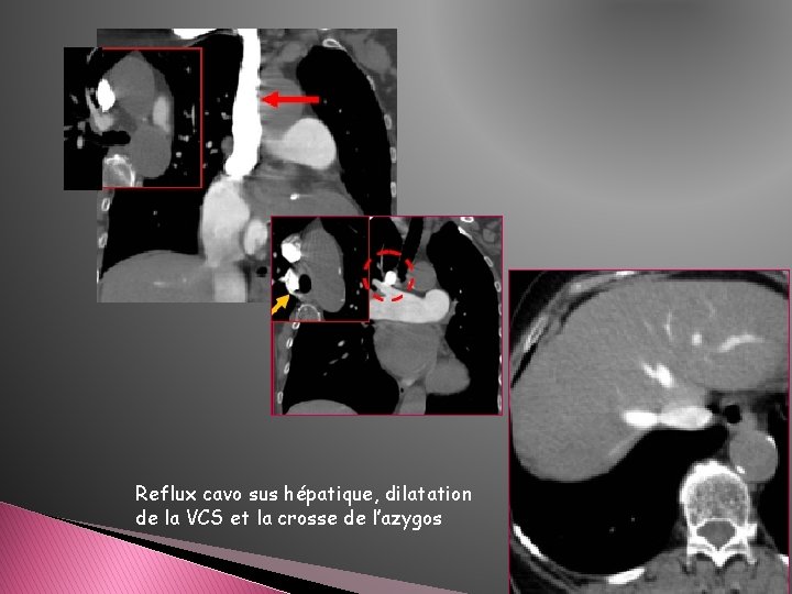 Reflux cavo sus hépatique, dilatation de la VCS et la crosse de l’azygos Reflux cavo sus hépatique, dilatation de la VCS et la crosse de l’azygos