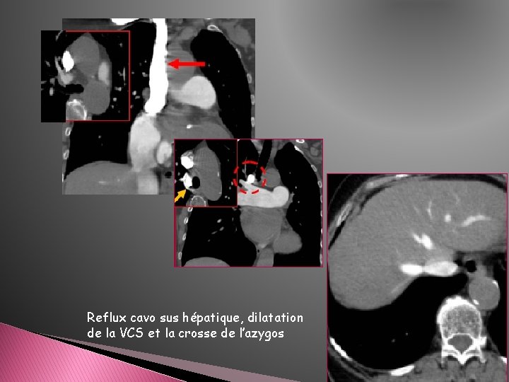 Reflux cavo sus hépatique, dilatation de la VCS et la crosse de l’azygos 