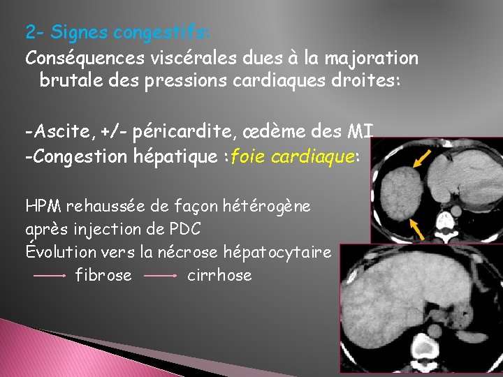 2 - Signes congestifs: Conséquences viscérales dues à la majoration brutale des pressions cardiaques 2 - Signes congestifs: Conséquences viscérales dues à la majoration brutale des pressions cardiaques