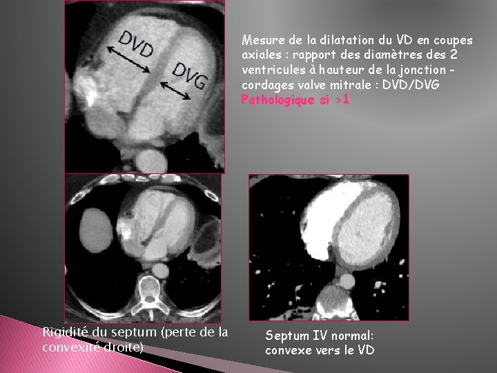 Mesure de la dilatation du VD en coupes axiales : rapport des diamètres des