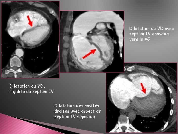 Dilatation du VD avec septum IV convexe vers le VG Dilatation du VD, rigidité