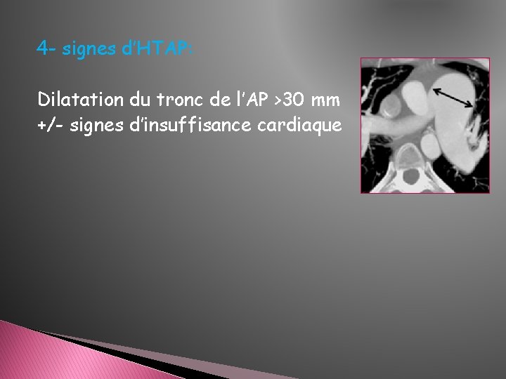 4 - signes d’HTAP: Dilatation du tronc de l’AP >30 mm +/- signes d’insuffisance 4 - signes d’HTAP: Dilatation du tronc de l’AP >30 mm +/- signes d’insuffisance