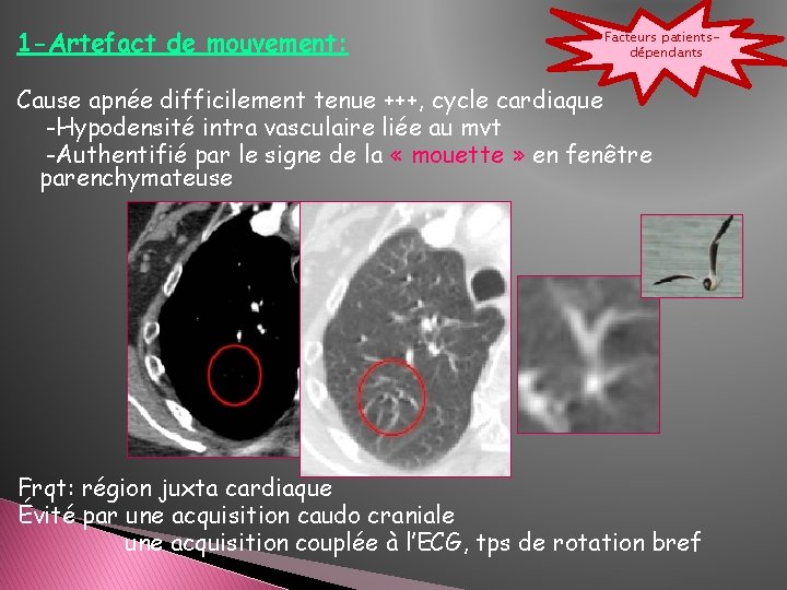 1 -Artefact de mouvement: Facteurs patientsdépendants Cause apnée difficilement tenue +++, cycle cardiaque -Hypodensité