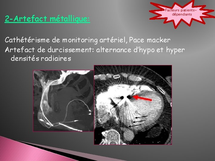 2 -Artefact métallique: Facteurs patientsdépendants Cathétérisme de monitoring artériel, Pace macker Artefact de durcissement: 2 -Artefact métallique: Facteurs patientsdépendants Cathétérisme de monitoring artériel, Pace macker Artefact de durcissement: