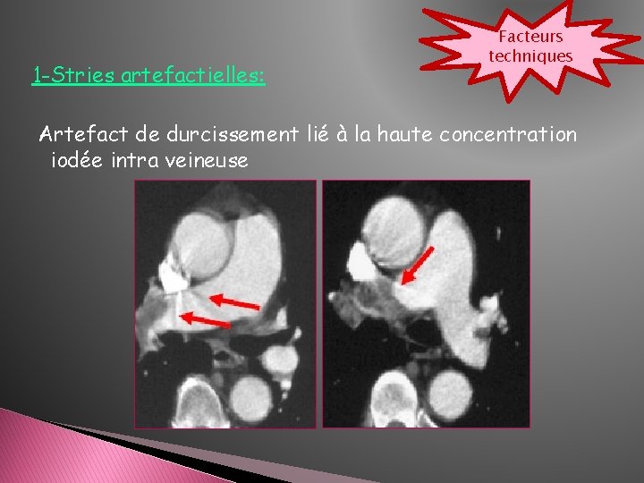 1 -Stries artefactielles: Facteurs techniques Artefact de durcissement lié à la haute concentration iodée