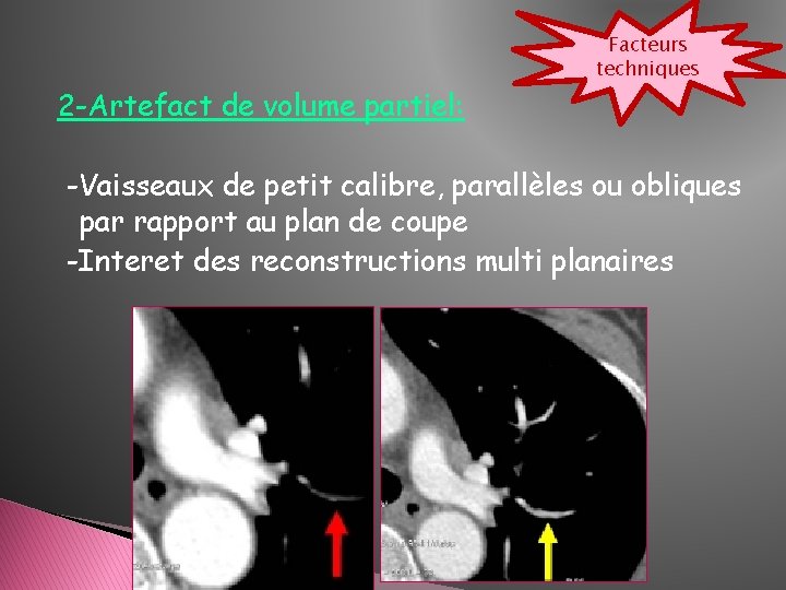 Facteurs techniques 2 -Artefact de volume partiel: -Vaisseaux de petit calibre, parallèles ou obliques Facteurs techniques 2 -Artefact de volume partiel: -Vaisseaux de petit calibre, parallèles ou obliques