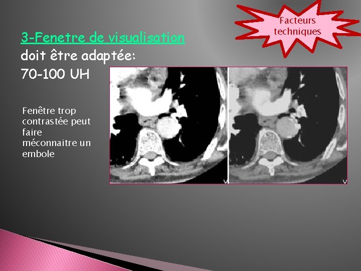 3 -Fenetre de visualisation doit être adaptée: 70 -100 UH Fenêtre trop contrastée peut 3 -Fenetre de visualisation doit être adaptée: 70 -100 UH Fenêtre trop contrastée peut