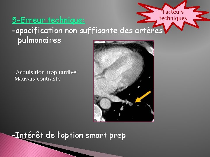 Facteurs techniques 5 -Erreur technique: -opacification non suffisante des artères pulmonaires Acquisition trop tardive: Facteurs techniques 5 -Erreur technique: -opacification non suffisante des artères pulmonaires Acquisition trop tardive: