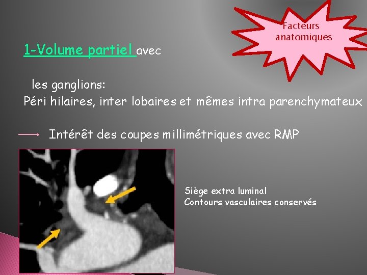 1 -Volume partiel avec Facteurs anatomiques les ganglions: Péri hilaires, inter lobaires et mêmes