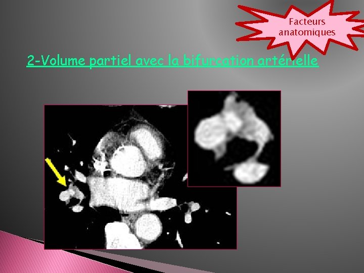 Facteurs anatomiques 2 -Volume partiel avec la bifurcation artérielle 