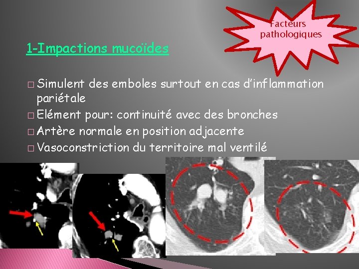 1 -Impactions mucoïdes � Simulent Facteurs pathologiques des emboles surtout en cas d’inflammation pariétale 1 -Impactions mucoïdes � Simulent Facteurs pathologiques des emboles surtout en cas d’inflammation pariétale