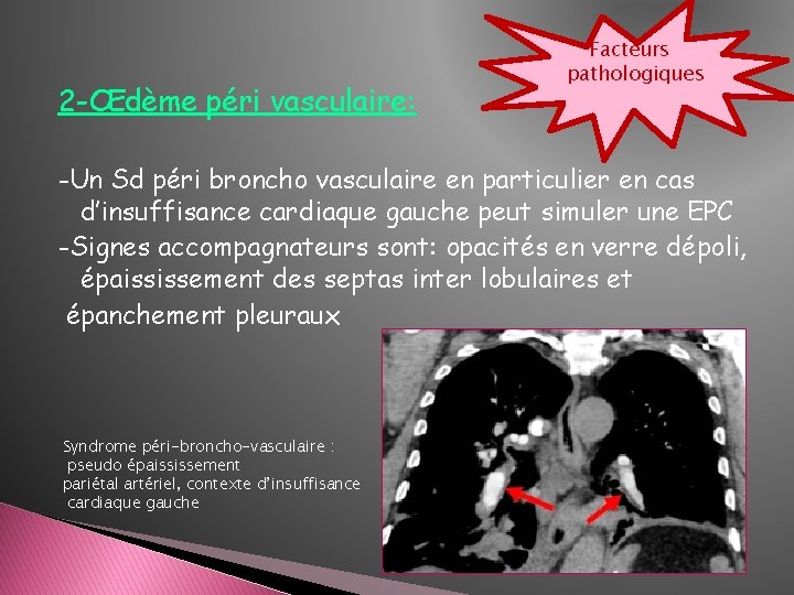 2 -Œdème péri vasculaire: Facteurs pathologiques -Un Sd péri broncho vasculaire en particulier en 2 -Œdème péri vasculaire: Facteurs pathologiques -Un Sd péri broncho vasculaire en particulier en