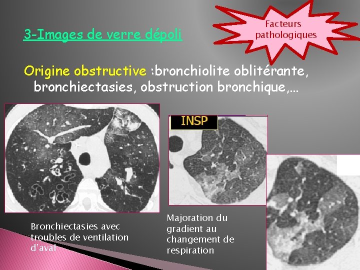 3 -Images de verre dépoli Facteurs pathologiques Origine obstructive : bronchiolite oblitérante, bronchiectasies, obstruction