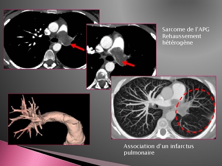 Sarcome de l’APG Rehaussement hétérogène Association d’un infarctus pulmonaire Sarcome de l’APG Rehaussement hétérogène Association d’un infarctus pulmonaire