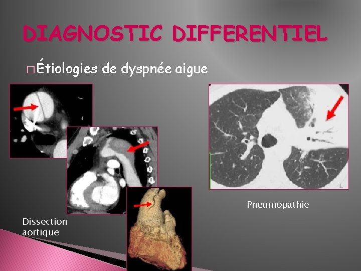 DIAGNOSTIC DIFFERENTIEL � Étiologies de dyspnée aigue Pneumopathie Dissection aortique 
