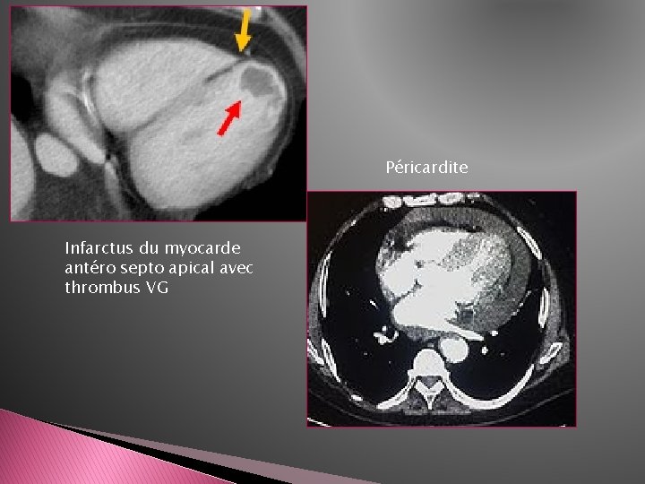 Péricardite Infarctus du myocarde antéro septo apical avec thrombus VG 