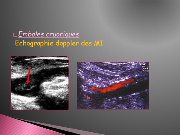 � Emboles cruoriques Echographie doppler des MI � Emboles cruoriques Echographie doppler des MI