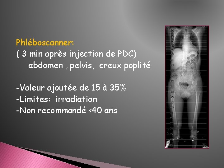 Phléboscanner: ( 3 min après injection de PDC) abdomen , pelvis, creux poplité -Valeur Phléboscanner: ( 3 min après injection de PDC) abdomen , pelvis, creux poplité -Valeur