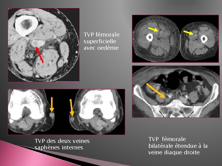 TVP fémorale superficielle avec oedème TVP des deux veines saphènes internes TVP fémorale bilatérale