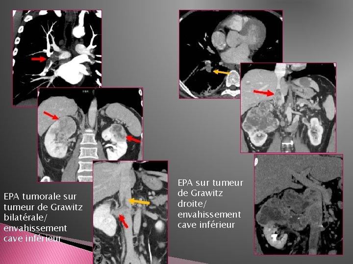 EPA tumorale sur tumeur de Grawitz bilatérale/ envahissement cave inférieur EPA sur tumeur de