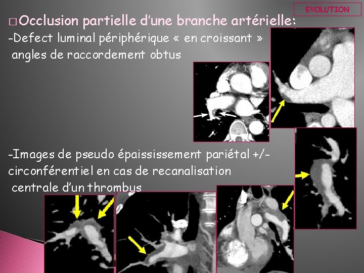 � Occlusion partielle d’une branche artérielle: -Defect luminal périphérique « en croissant » angles � Occlusion partielle d’une branche artérielle: -Defect luminal périphérique « en croissant » angles