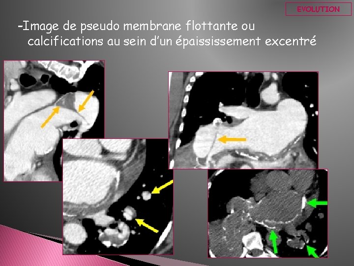 EVOLUTION -Image de pseudo membrane flottante ou calcifications au sein d’un épaississement excentré 